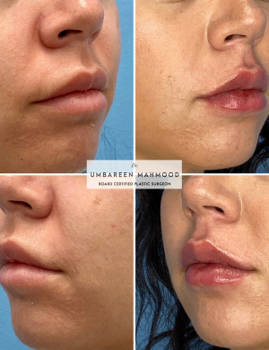 lip-fillers-3