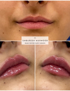 lip-fillers-5