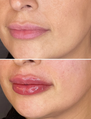 lip-fillers-6