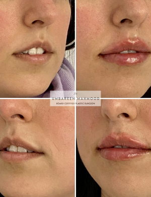 lip-fillers-7