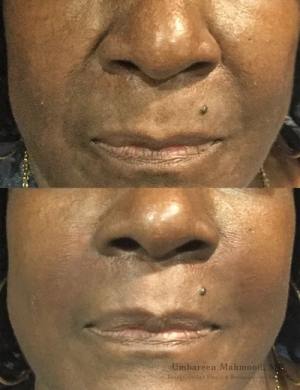 lip-fillers-min