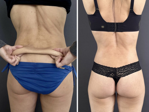 lower-body-lift-plastic-surgery-nyc-before-after-1