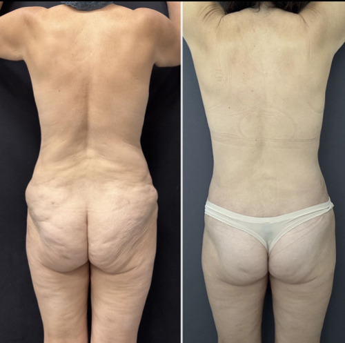 lower-body-lift-plastic-surgery-nyc-before-after-2
