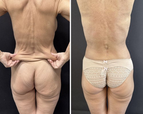 lower-body-lift-plastic-surgery-nyc-before-after-3
