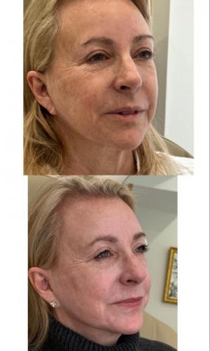 microneedling-nyc-before-after-10