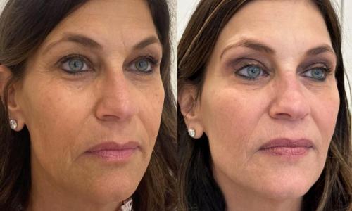 microneedling-nyc-before-after-11