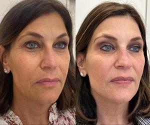microneedling-nyc-before-after-11