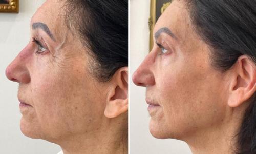 microneedling-nyc-before-after-12