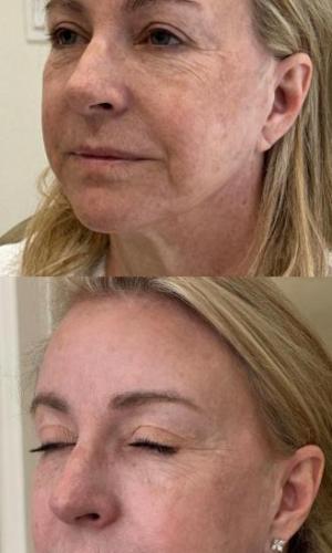 microneedling-nyc-before-after-13