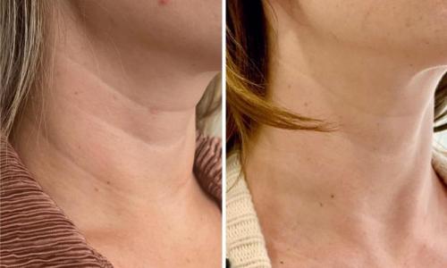 microneedling-nyc-before-after-14