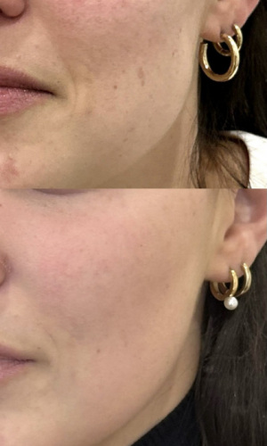 microneedling-nyc-before-after-15