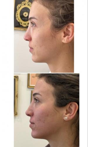 microneedling-nyc-before-after-16