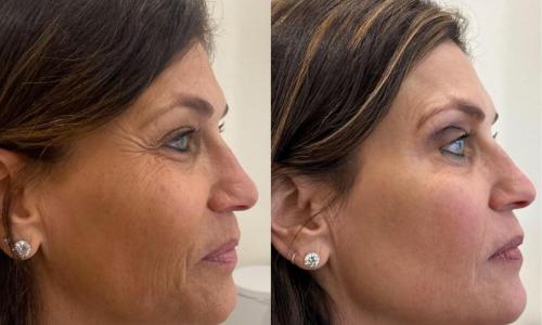 microneedling-nyc-before-after-2