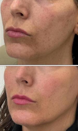 microneedling-nyc-before-after-3