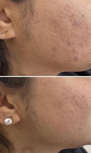 microneedling-nyc-before-after-4