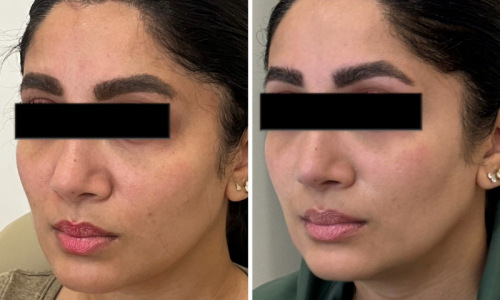 microneedling-nyc-before-after-5