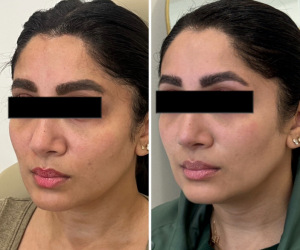 microneedling-nyc-before-after-5