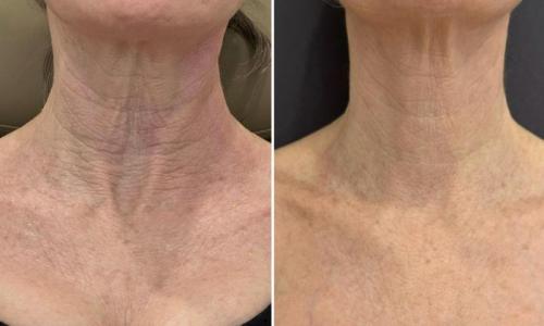 microneedling-nyc-before-after-6