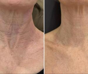 microneedling-nyc-before-after-6