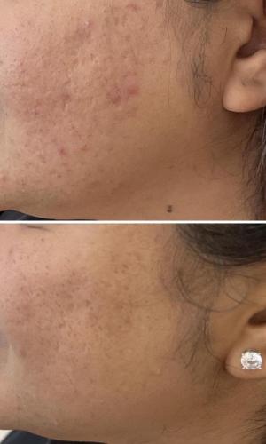 microneedling-nyc-before-after-7