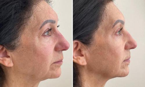 microneedling-nyc-before-after-8