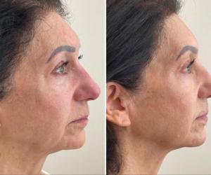 microneedling-nyc-before-after-8