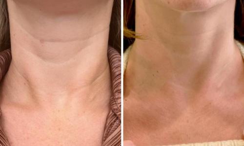 microneedling-nyc-before-after-9