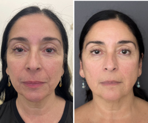 microneedling-radiofrequency-nyc-before-after-1-1