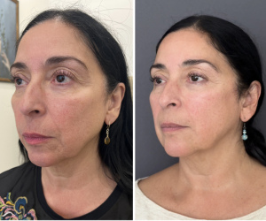 microneedling-radiofrequency-nyc-before-after-1-2