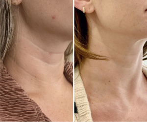 rf-microneedling-before-and-after-10