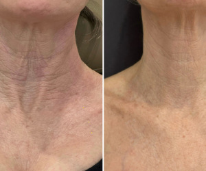 rf-microneedling-before-and-after-11