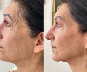 rf-microneedling-before-and-after-5-1