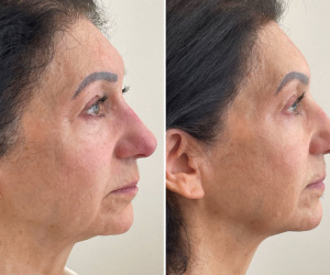 rf-microneedling-before-and-after-5-2