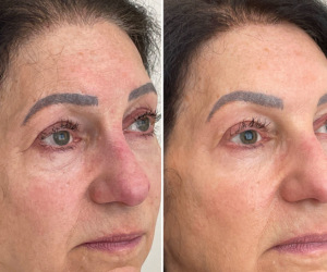 rf-microneedling-before-and-after-5-3