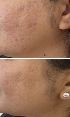 rf-microneedling-before-and-after-6