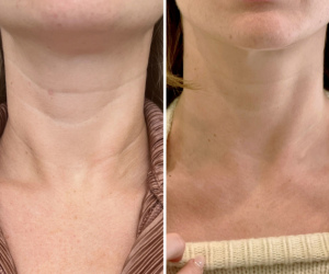 rf-microneedling-before-and-after-8