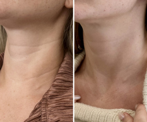 rf-microneedling-before-and-after-9