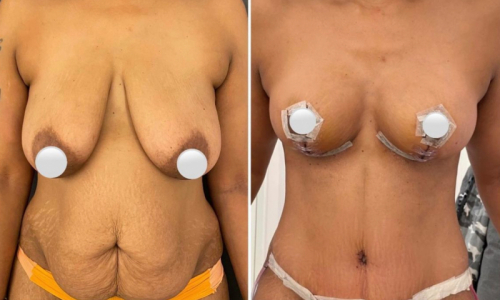 Before-after-mommy-makeover-7