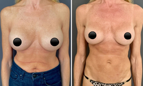 Before-after-mommy-makeover-8