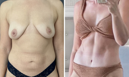 Before-after-mommy-makeover-nyc-10