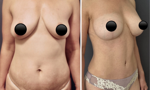 Before-after-mommy-makeover-nyc-9