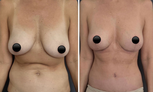 Before-after-mommy-makeover-plastic-surgery-nyc-14