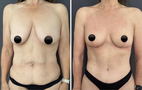 Before-after-mommy-makeover-plastic-surgery-nyc-15