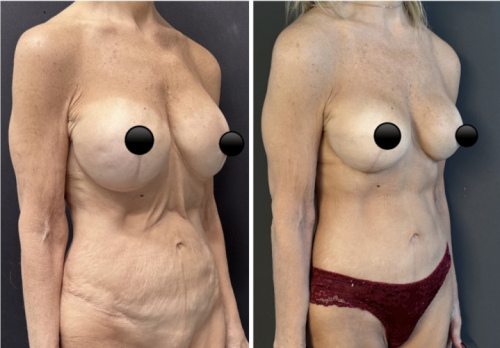Before-after-mommy-makeover-plastic-surgery-nyc-20-2