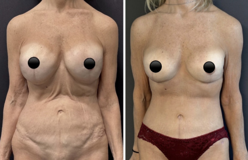 Before-after-mommy-makeover-plastic-surgery-nyc-20
