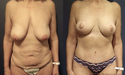 Before-after-mommy-makeover