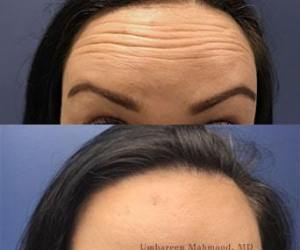 botox-female-forehead-min-1