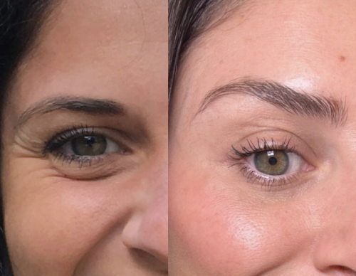 eye-brow-lift-before-after