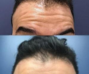 male-botox-forehead-min