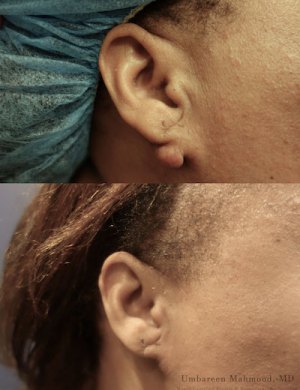 before-after-mole-removal-2